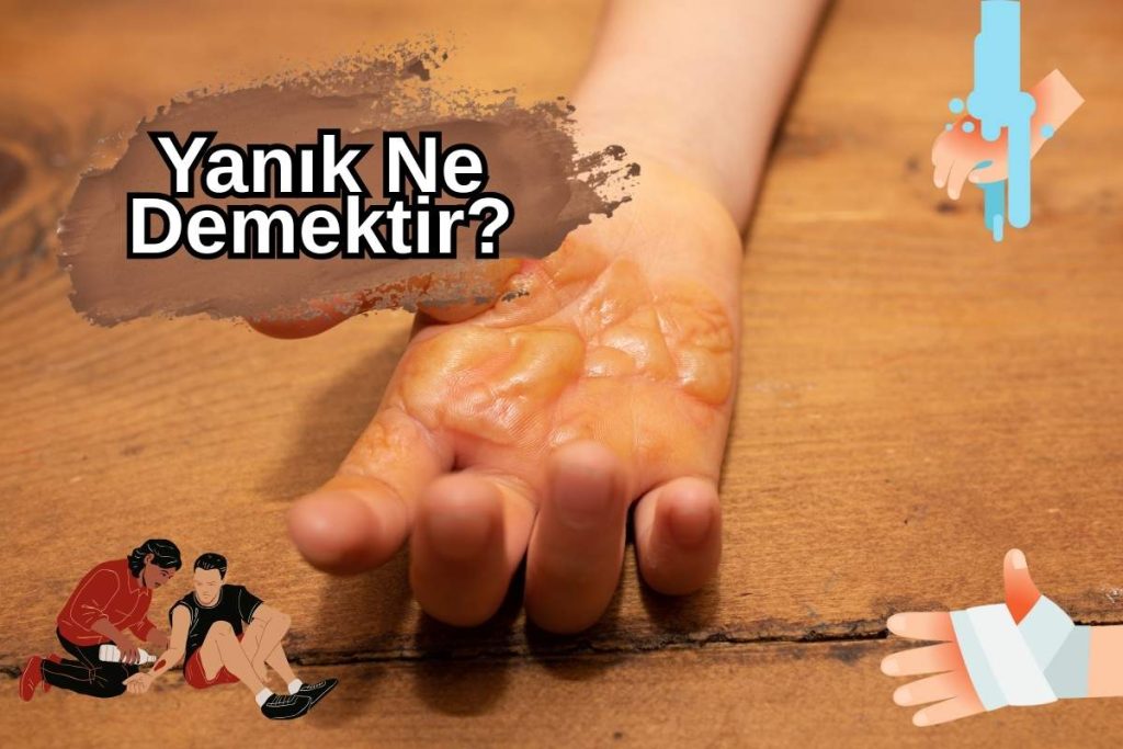 Yanık Ne Demektir?